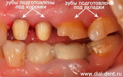 Восстановление зубов вкладками и коронками