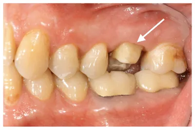 Установка керамических зубных вкладок в стоматологии Лагуна Стом