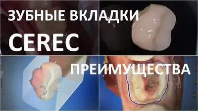 Зубные вкладки и модули CEREC в Москве, цены | Альянс бьюти-ортопедов,  Москва