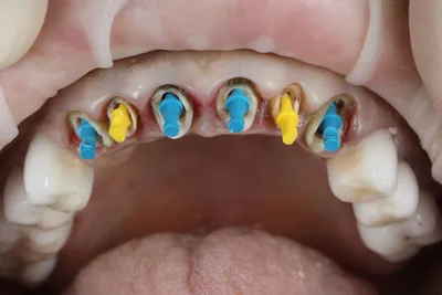 Культевые вкладки на передние зубы | Как делают?