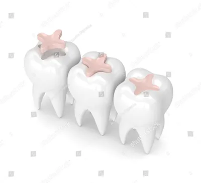 Вкладка на зуб - Стоматология \"Феликс\"