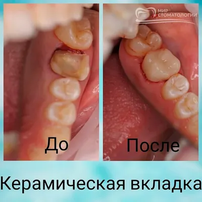 Вкладки на зубы во Владимире: цены от стоматологии Мир стоматологии