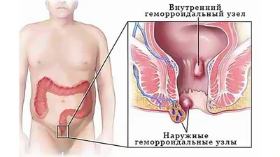 Лечение геморроя — Киев, Цена ➨ Удаление геморроя в Сити Клиника