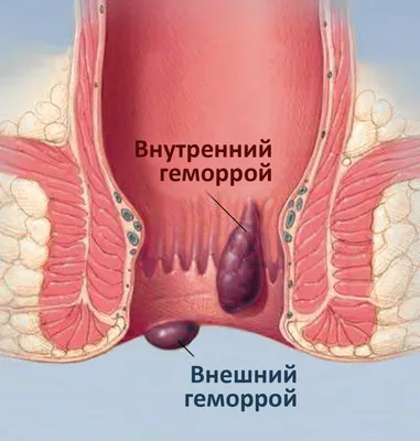 Лечение геморроя в СПб (Выборгский район) - цены лечения геморроя в клинике  | Медицинский центр - МедПросвет