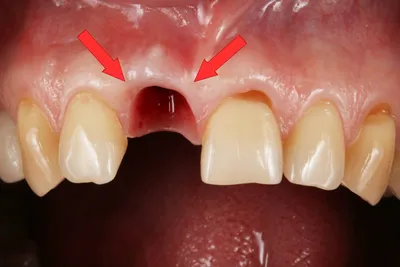 Формирование десны при имплантации зубов - примеры с фото