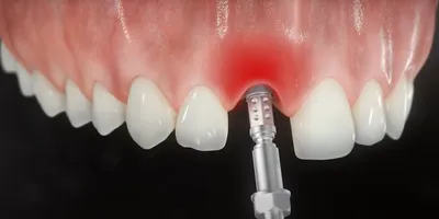 Боль после имплантации зубов - причины, сколько длится, способы снять боль  у импланта