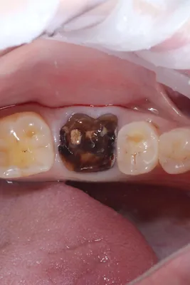 Одномоментная имплантация, удаление зуба