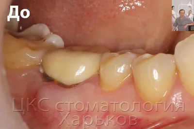 Зубная имплантация без хирургических разрезов. Немедленная имплантация в  ЦКС Харьков