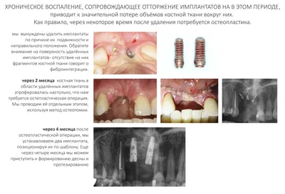 CLINICIN.RU | Отторжение зубных имплантатов: причины, симптомы, лечение
