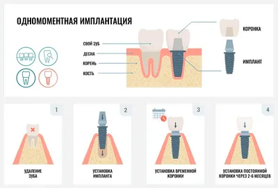 Одномоментная имплантация зубов — Сравнение, преимущества, недостатки