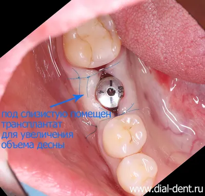 Пластика десны в области имплантации и протезирование жевательного зуба