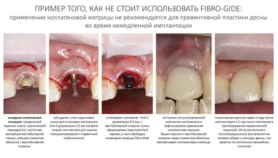 Отторжение зубных имплантатов: причины, симптомы, лечение.