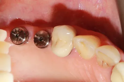 Имплантация зубов (имплантация зуба) - цена, стоимость установки зубных  имплантов в Киеве - Имплантация | Certus
