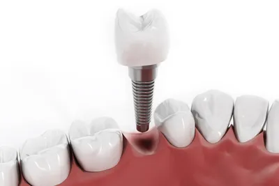 Что нужно знать после имплантации зубов - Полезные статьи на сайте  стоматологической клиники Церекон