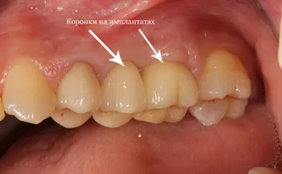 Формирование десны при имплантации зубов - примеры с фото