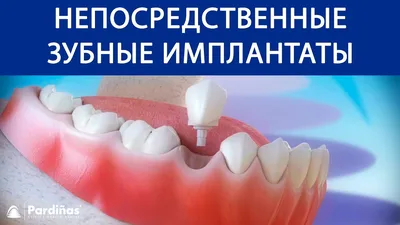 Имплантация зубов в Москве — центр имплантологии — Стоматология «Мир  здоровья»