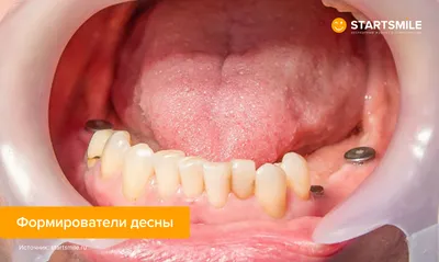 Одномоментная имплантация зубов – отзывы, плюсы установки импланта сразу  после удаления зуба, противопоказания