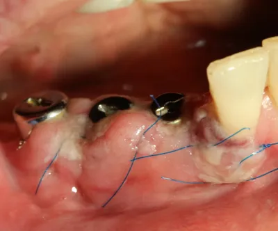 Послеоперационный период после имплантации зубов • Alba Avis