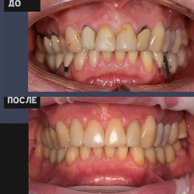 Имплантация зубов при пародонтозе | НК Клиник
