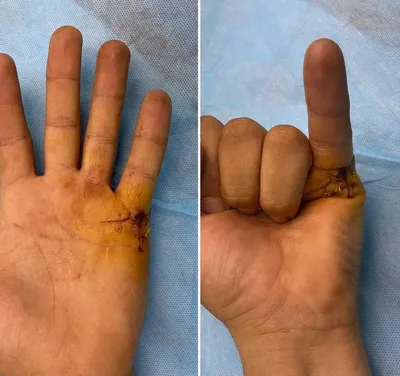 Разрыв сухожилия на пальце руки: первая помощь и способы лечения
