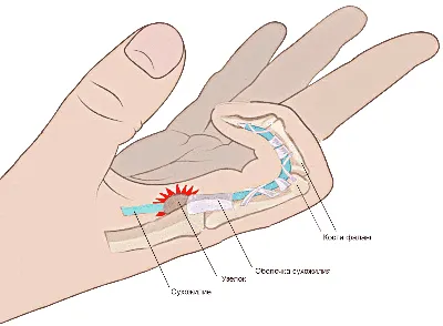 Лечение щёлкающего пальца (болезнь Нотта) в Астане - HANDSURGERY