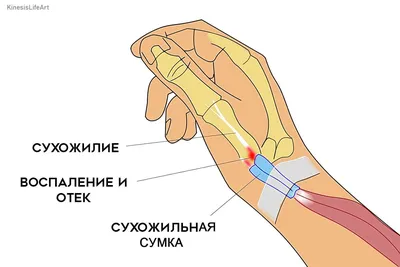 Тендинит. Лечение восспаления сухожилья безоперационными методами в Киеве
