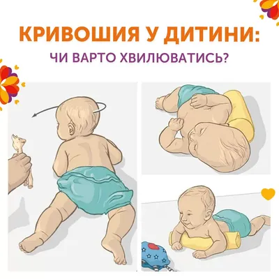 Кривошия у немовлят фото