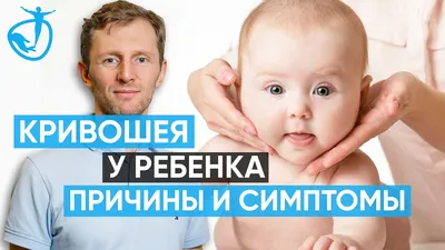 КРИВОШЕЯ У РЕБЕНКА. Причины появления кривошеи и симптомы // Владимир Животов - YouTube