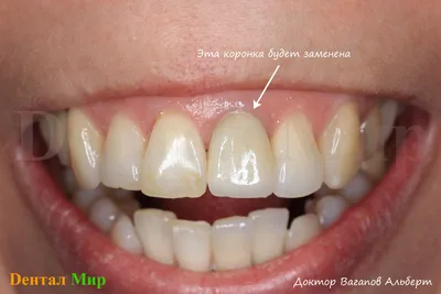 Замена безметалловой керамической коронки на эстетическую | Стоматология  Дентал Мир