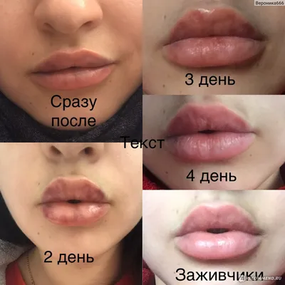 Гиалуроновая кислота увеличение губ до и после фото