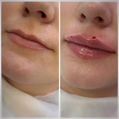 Красивые губы как #увеличить губы | Губы, Увеличение губ, Косметология