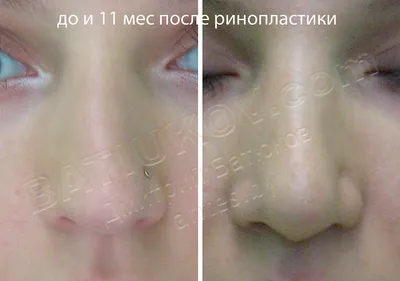Ринопластика, пластика носа в Минске, цены, фото до и после, отзывы