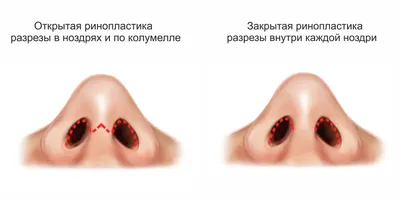 Ринопластика (пластика носа)