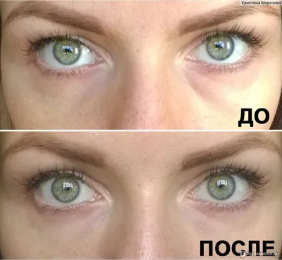 Биоревитализация кожи вокруг глаз. Инъекции гиалуроновой кислоты - «На 10  лет моложе!» | отзывы