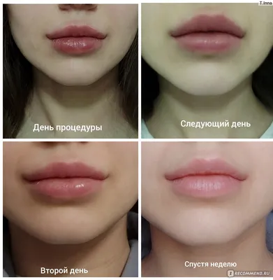 Увеличение / Аугментация губ с помощью препарата гиалуроновой кислоты -  «Увеличение губ, фото на разных стадиях» | отзывы