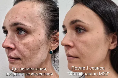 Эрбиевый лазер Resurfx для омоложения кожи в Ижевске