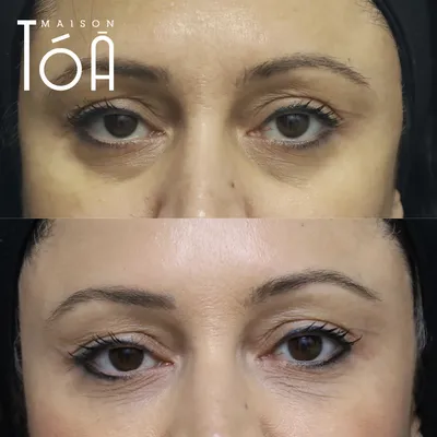 Injections Filler, Dr Sophie Nordback, Alexandra Miles