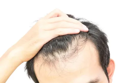 Диффузное выпадение волос фото