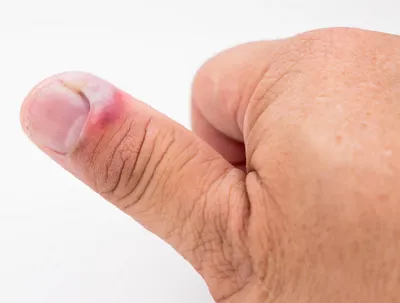 Лечение воспаления ногтя большого пальца | Вылечить воспаление около / под  ногтем пальца на ноге / руке в Москве в Клинике Подологии