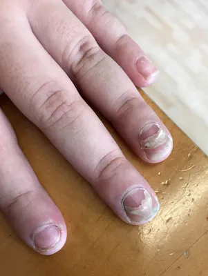 Средство для укрепления ногтей Чудо Хаш Гель - «Что делать, если ногти  слоятся и ломаются? Из-за дерматита стригла под самый корень. Гель помог  восстановить ногти всего за 2 недели. Фото результата.» | отзывы