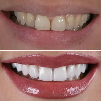 Люминиры на зубы: что это такое, фото до и после