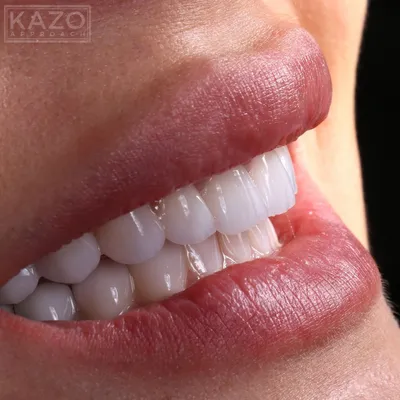 Идеи на тему «Виниры Арт» (7) | стоматология, зубы, кривые