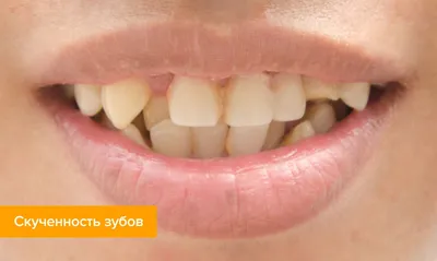Скученность зубов: лечение, фото, причины — в статье на Startsmile.ru