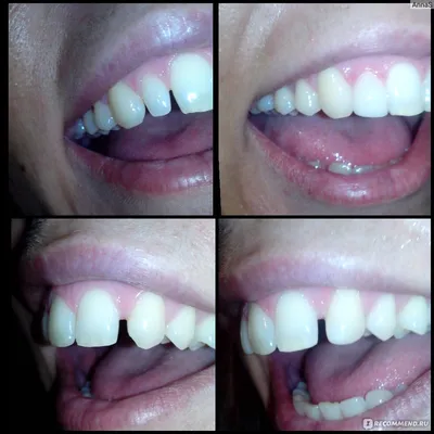 Эстетическая стоматология - художественная реставрация зубов - «Если на  люминиры денег не хватает, виниры пугают, а улыбаться хочется во все 32!!!»  | отзывы