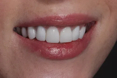 Можно ли винирами исправить прикус и кривые зубы, они их выравнивают?