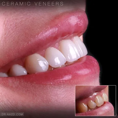 Идеи на тему «Виниры Арт» (7) | стоматология, зубы, кривые