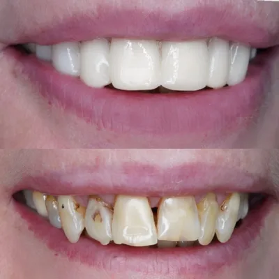 Виниры восстановление зубов в Уфе по цене от 3000 руб.
