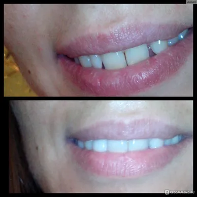 Эстетическая стоматология - художественная реставрация зубов - «Если на  люминиры денег не хватает, виниры пугают, а улыбаться хочется во все 32!!!»  | отзывы