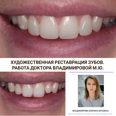 Художественная реставрация зубов, наращивание и восстановление зубов