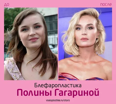 Полина Гагарина до и после блефаропластики